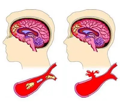 脑卒中方向精选论文范文合集91学术